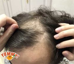-大麦微针植发全国连锁