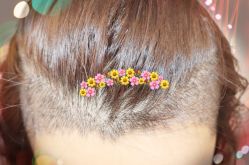 -大麦微针植发全国连锁