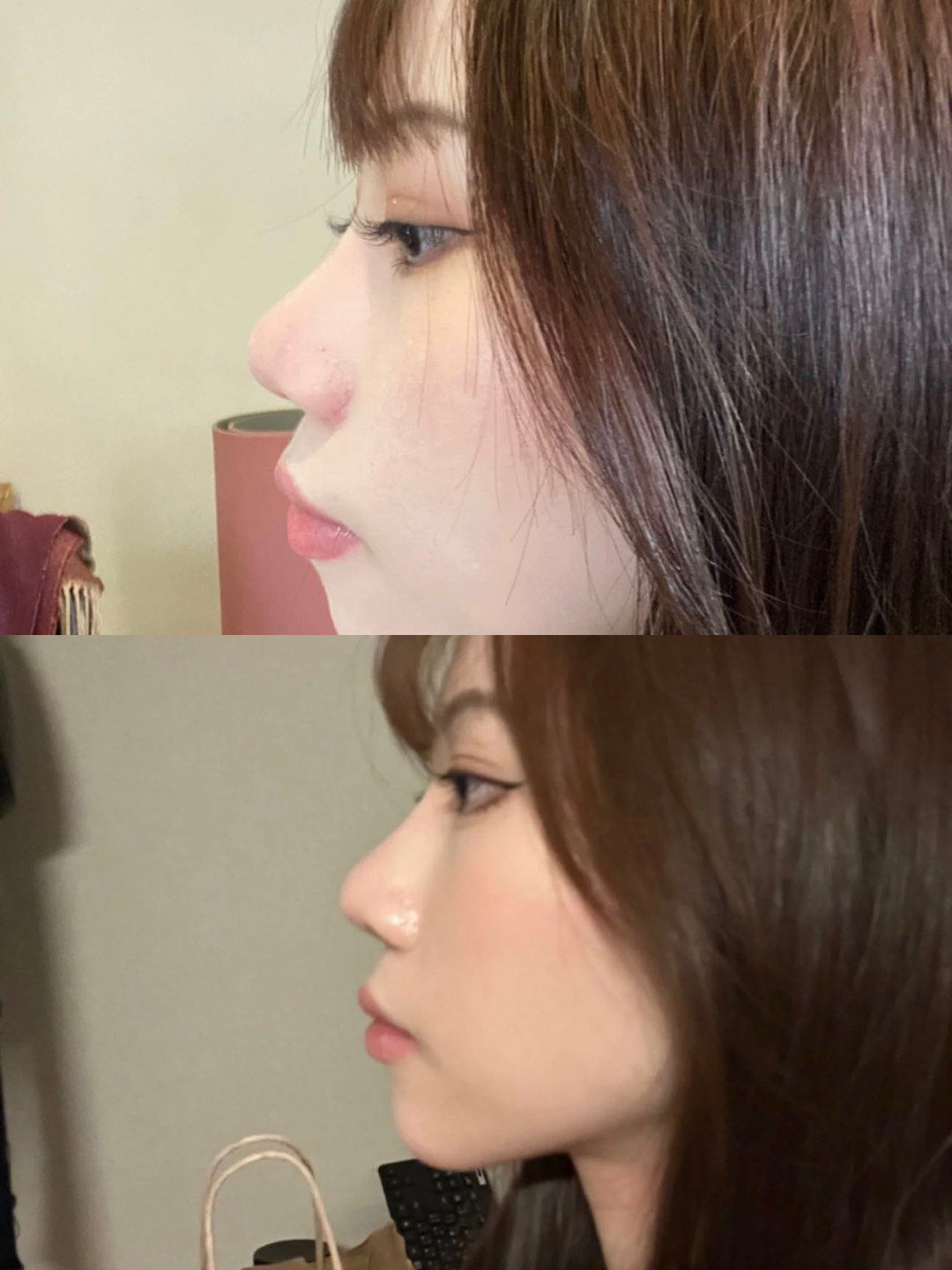 整牙前后对比 !变化震惊我!从凸嘴变身正常