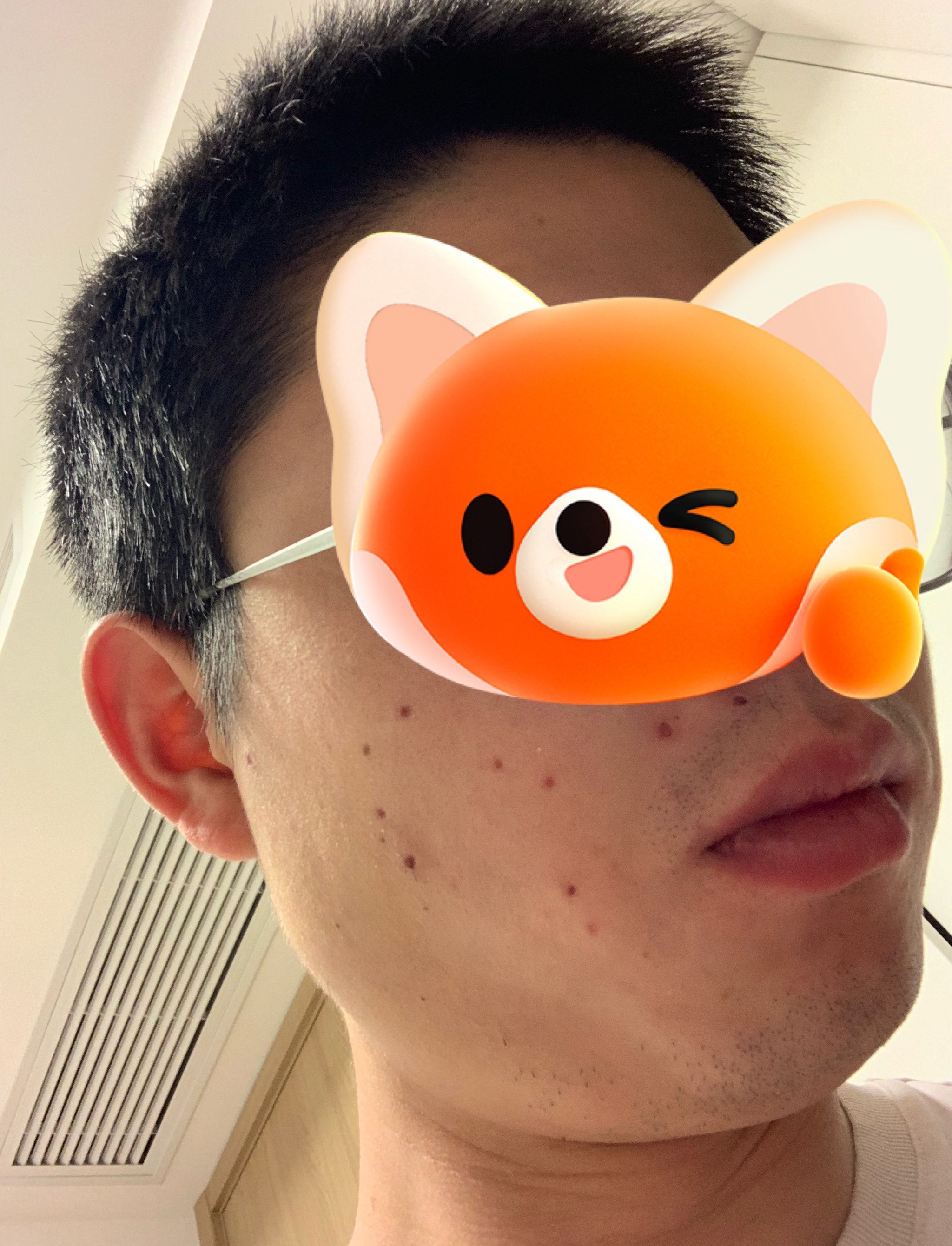 第一次体验点痣