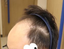 -大麦微针植发全国连锁