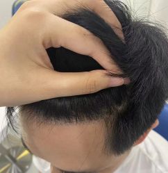 -大麦微针植发全国连锁