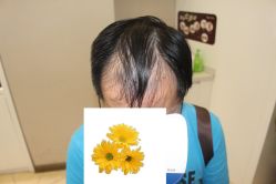 -大麦微针植发丨全国连锁