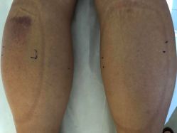 -肥三针腧穴瘦身馆