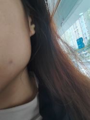 体验后-成都军建医院·疤痕诊疗中心