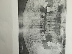 -上海仁爱医院口腔科 · 种植