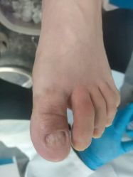 -德哥灰指甲脚气甲沟炎跖疣护理