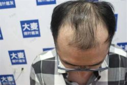 -大麦微针植发丨全国连锁