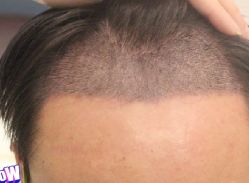 -大麦微针植发丨全国连锁