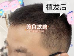 -大麦微针植发全国连锁