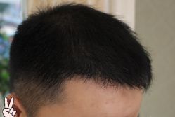 -大麦微针植发丨全国连锁