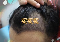 -大麦微针植发全国连锁