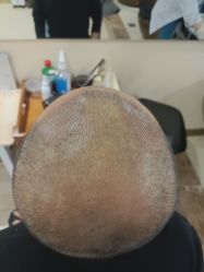 -碧莲盛·不剃发植发