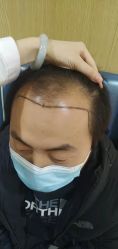 -大麦微针植发丨全国连锁