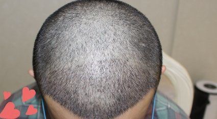 -大麦微针植发丨全国连锁