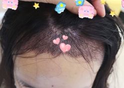 -大麦微针植发全国连锁