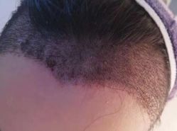 -大麦微针植发丨全国连锁