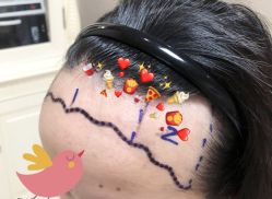 -大麦微针植发全国连锁