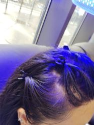 -碧莲盛·不剃发植发