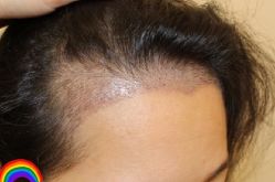 -大麦微针植发丨全国连锁