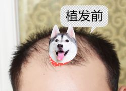 -大麦微针植发全国连锁