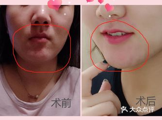 痘痘肌都可以尝试，亲测有效果