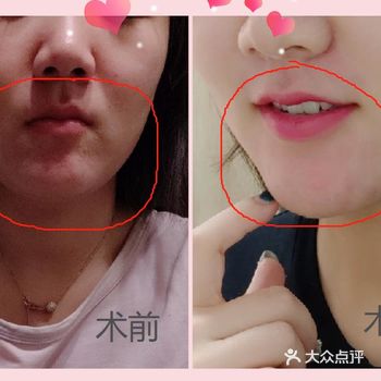 痘痘肌都可以尝试，亲测有效果