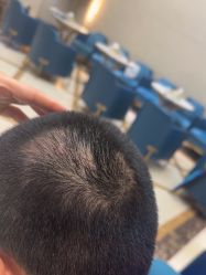 -碧莲盛·不剃发植发