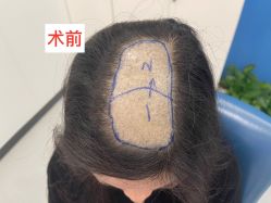 点击看大图 体验前-大麦微针植发全国连锁