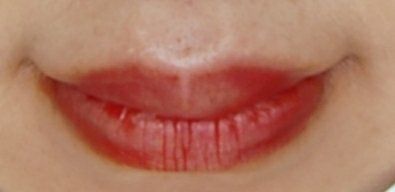 体验后-苏州卫康美容医院