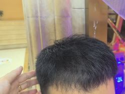 -碧莲盛·不剃发植发