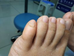 -派恩宜灰指甲鸡眼嵌甲手足癣