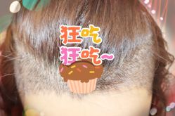 -大麦微针植发全国连锁