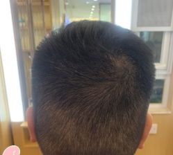 -大麦微针植发丨全国连锁