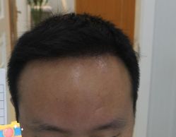 -大麦微针植发丨全国连锁