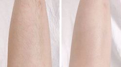 -薇兰专业脱毛连锁机构