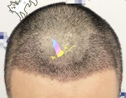 -大麦微针植发全国连锁