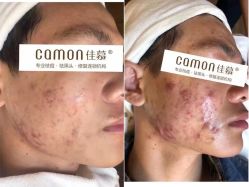 -佳慕·痘痘·问题肌管理中心