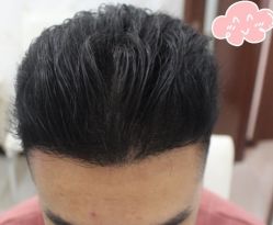 -大麦微针植发丨全国连锁