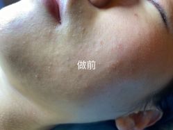 -爱莎扁平疣·汗管瘤·斑痣中心