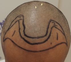 -大麦微针植发全国连锁