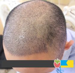 -大麦微针植发丨全国连锁