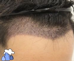 -大麦微针植发丨全国连锁