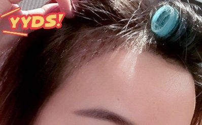 -大麦微针植发丨全国连锁