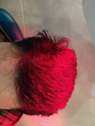 -碧莲盛·不剃发植发