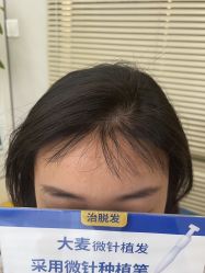 -大麦微针植发丨全国连锁