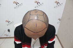 -大麦微针植发丨全国连锁