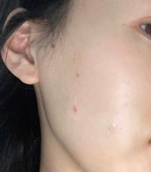 体验后-空军总医院激光整形美容中心
