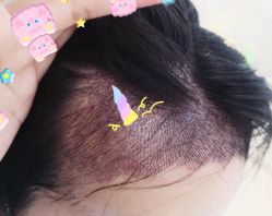 -大麦微针植发全国连锁