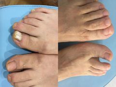 -世龙世家灰指甲·甲沟炎·跖疣护理·修脚(东江湾路店)